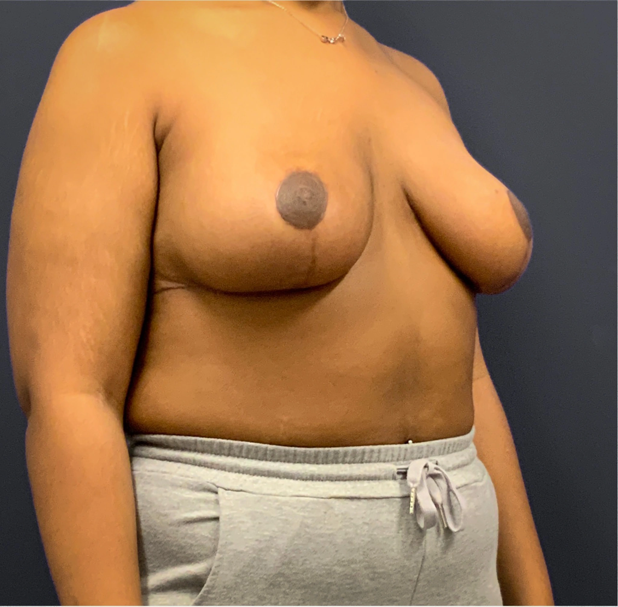 Breast-Reduction-Case--5320 | After Breast Reduction 5