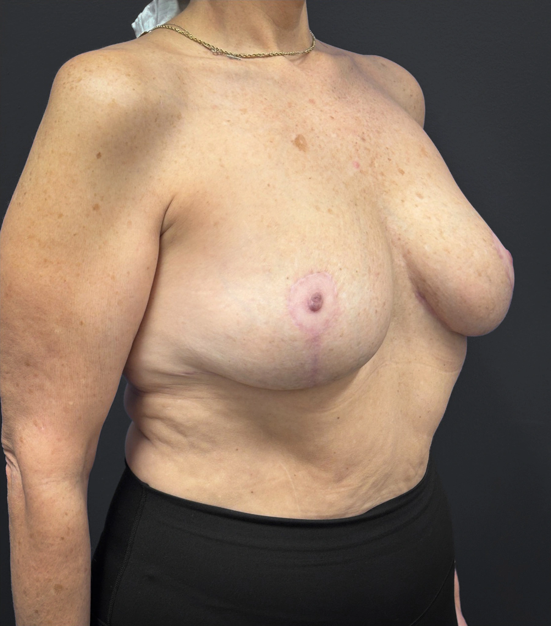 Breast-Reduction-Case--2538 | After Breast Reduction 5