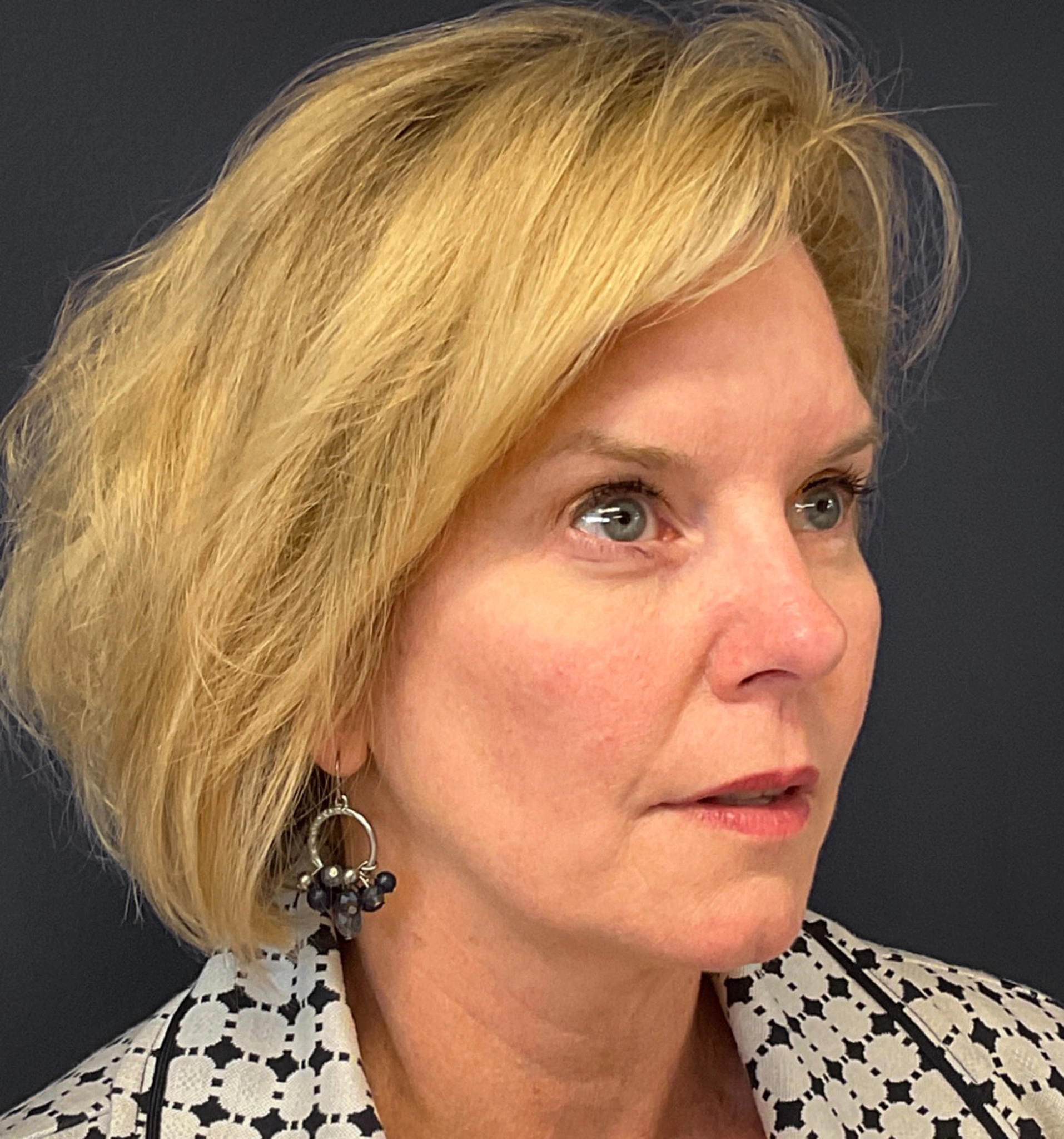 Blepharoplasty-Case--7015 | After Eyelid Surgery 6