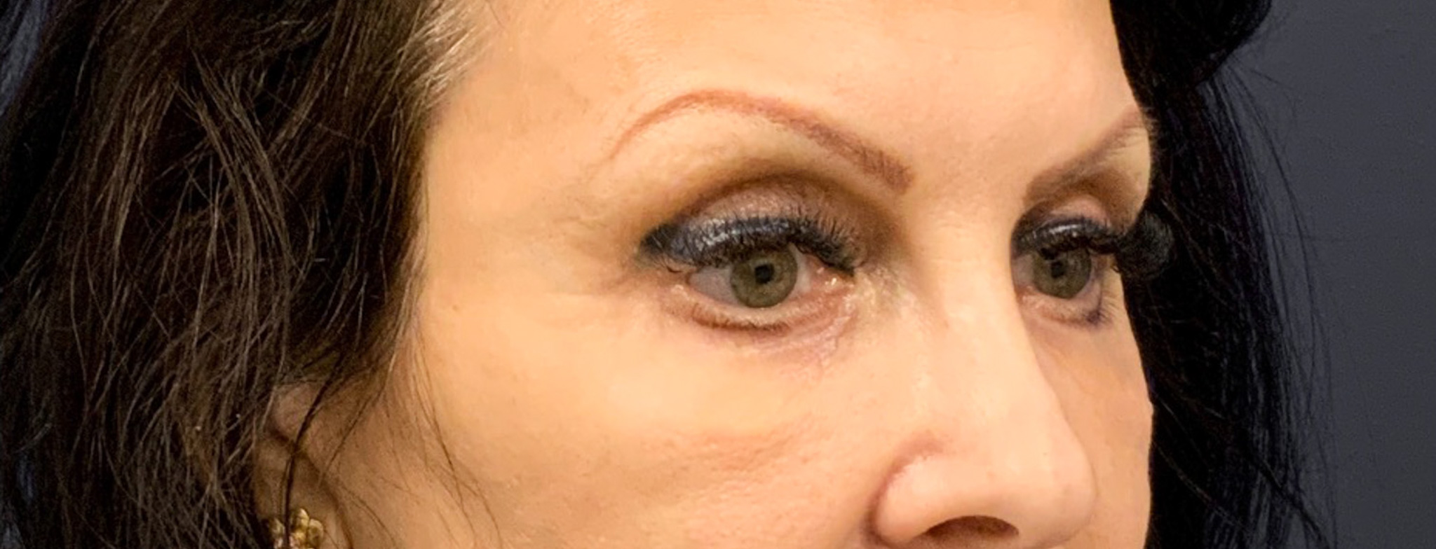 Blepharoplasty-Case--6272 | After Eyelid Surgery 9