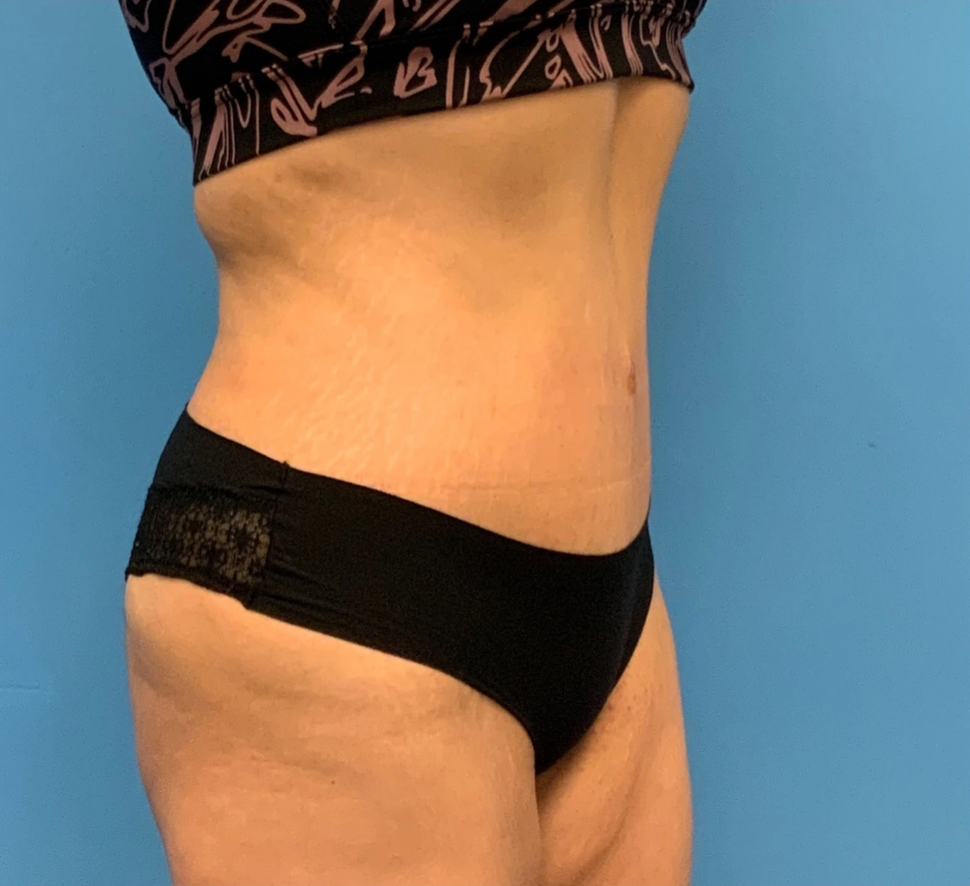 Abdominoplasty-Case--23747 | After Tummy Tuck 4