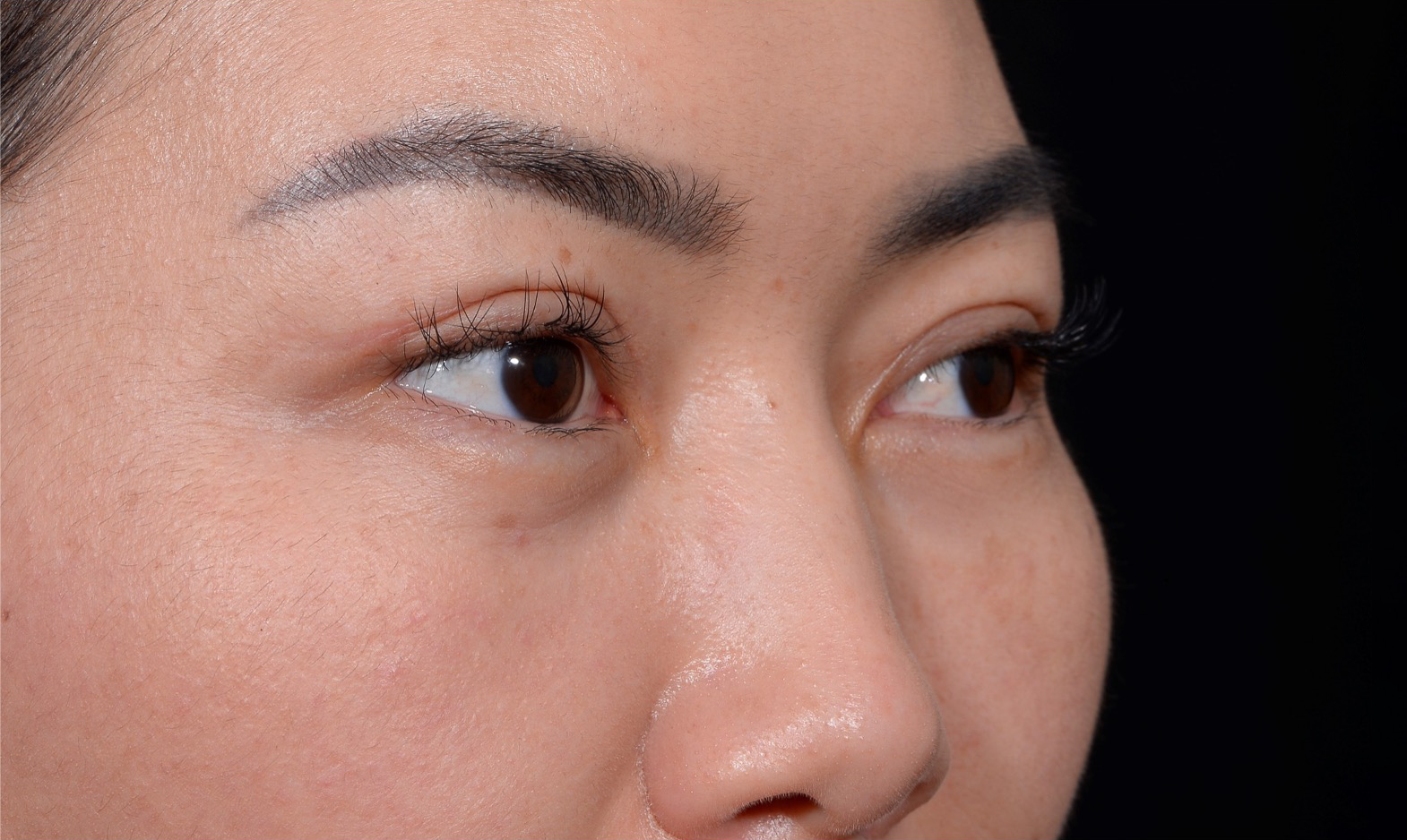 Blepharoplasty-Case--356 | After Eyelid Surgery 3