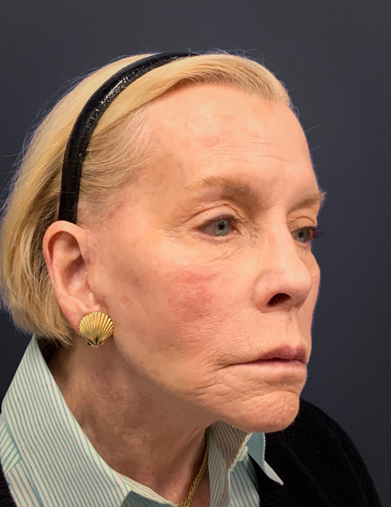 Facelift-Case--7247 | After Facelift 4