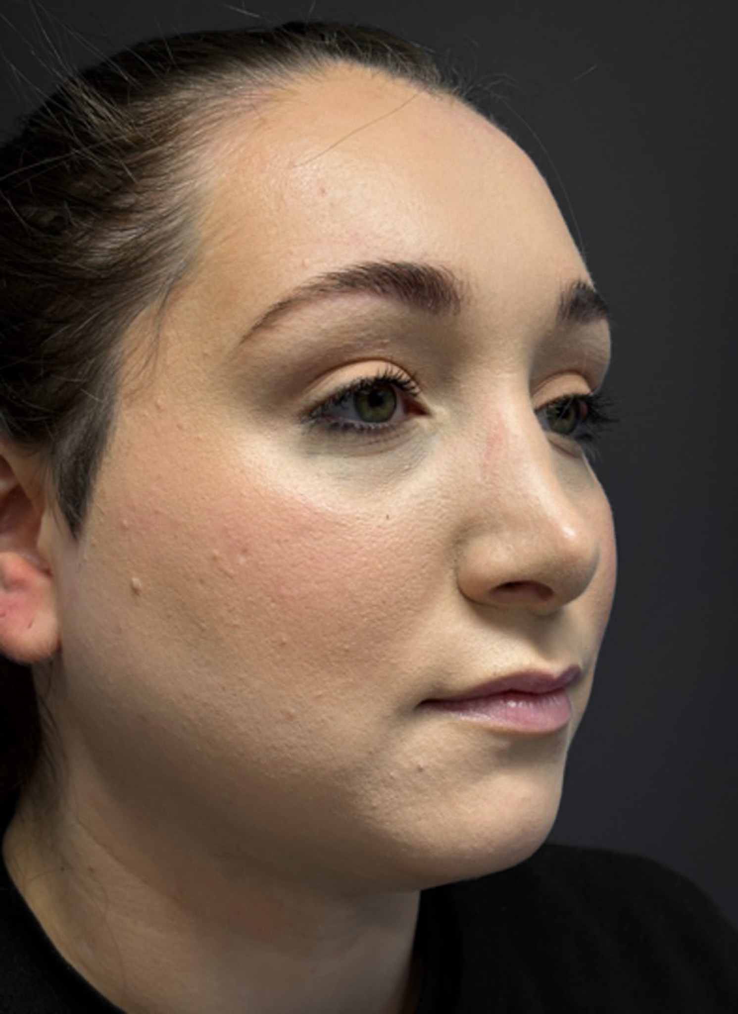 Submental-Liposuction-Case--3439 | After Submental Liposuction 4