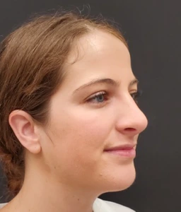 Rhinoplasty-and-Chin-Implant-Case--381 | After Rhinoplasty 2