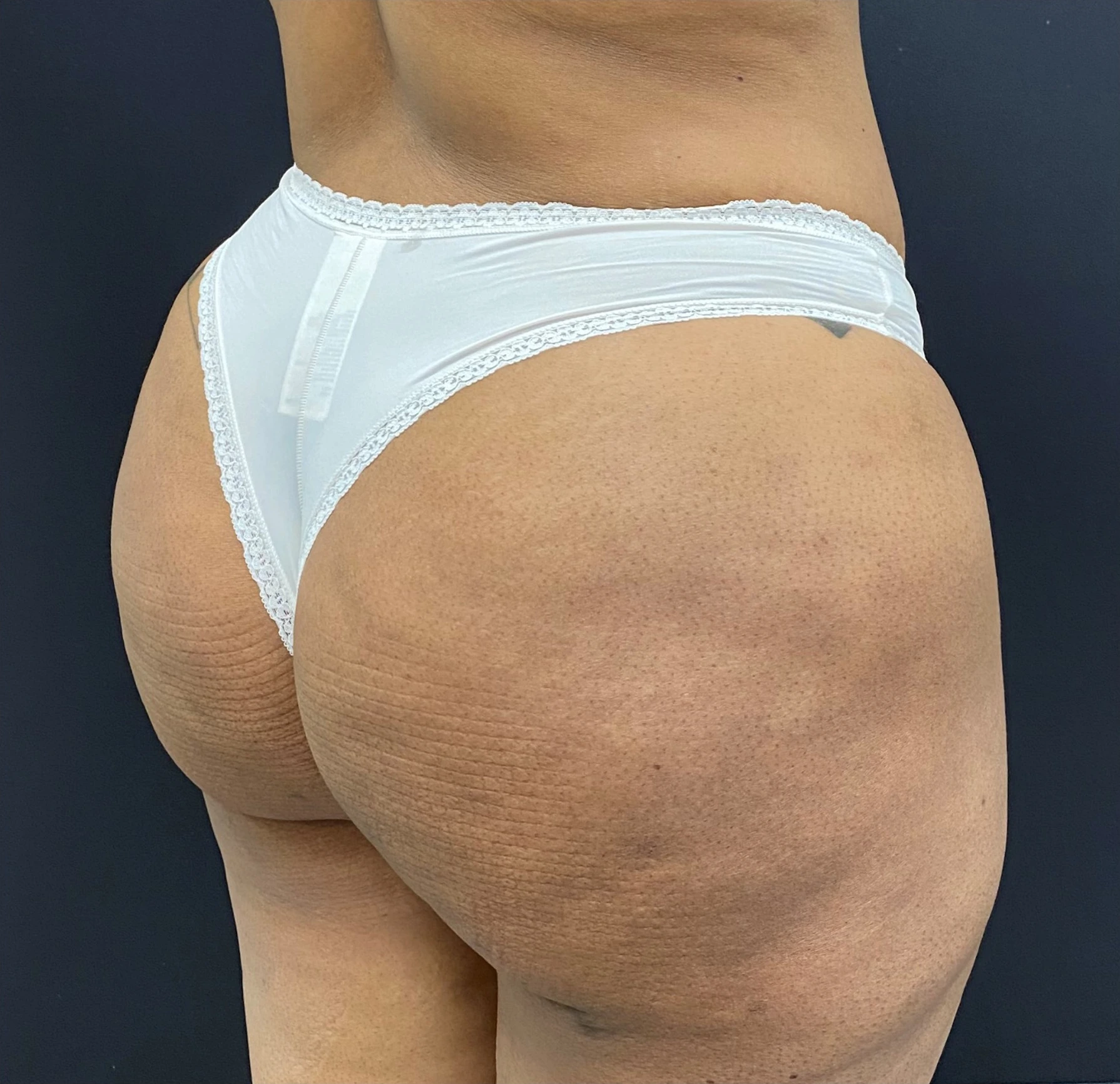 Brazilian-Butt-Lift-Case--352 | After Brazilian Butt Lift 2