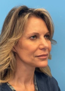 Facelift-Case--18078 | After Facelift 2