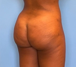 Brazilian-Butt-Lift-Case--263 | After Brazilian Butt Lift 2