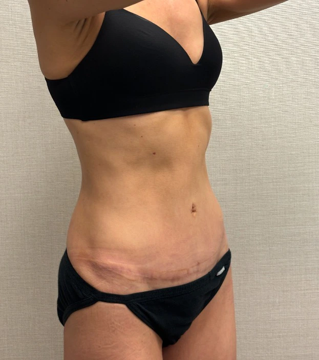 Revision-Tummy-Tuck-Case--23643 | After Tummy Tuck 4