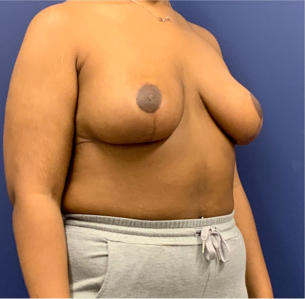 Breast-Reduction-Case--27281 | After Breast Reduction 4