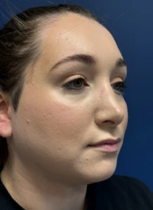 Submental-Liposuction-Case--29107 | After Submental Liposuction 2