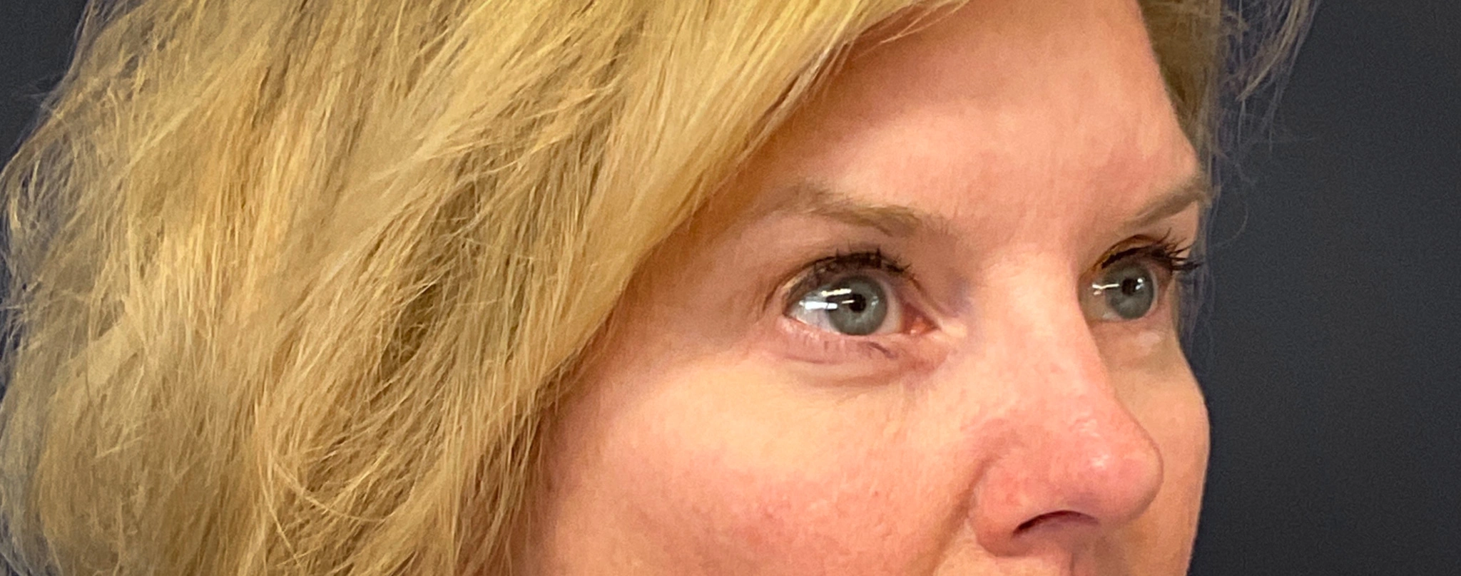Blepharoplasty-Case--7015 | After Eyelid Surgery 3