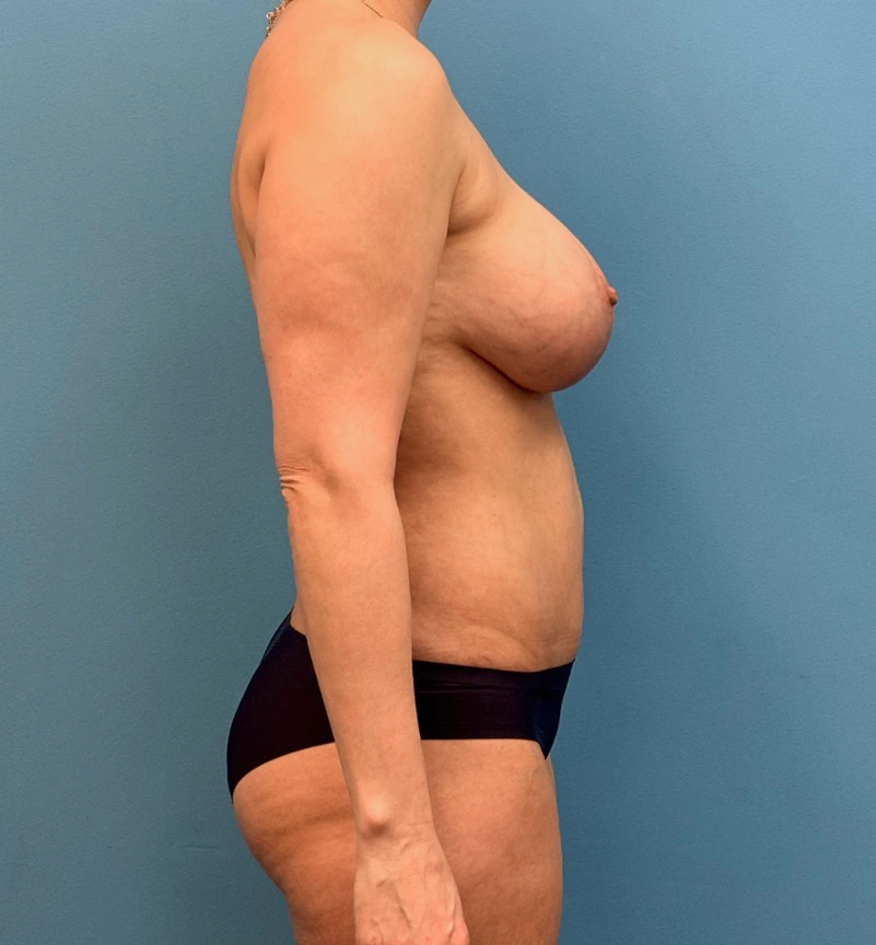 Breast-Augmentation-Tummy-Tuck-Case--28080 | After Body Lift 4