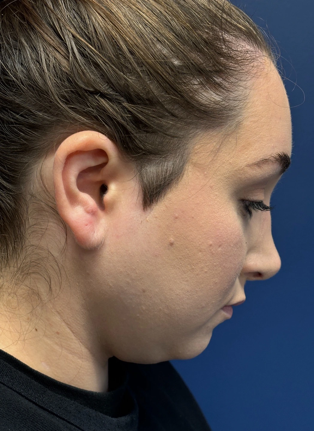 Submental-Liposuction-Case--29107 | After Submental Liposuction 6