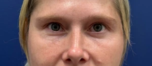 Blepharoplasty-Case--29601 | After Eyelid Surgery 2