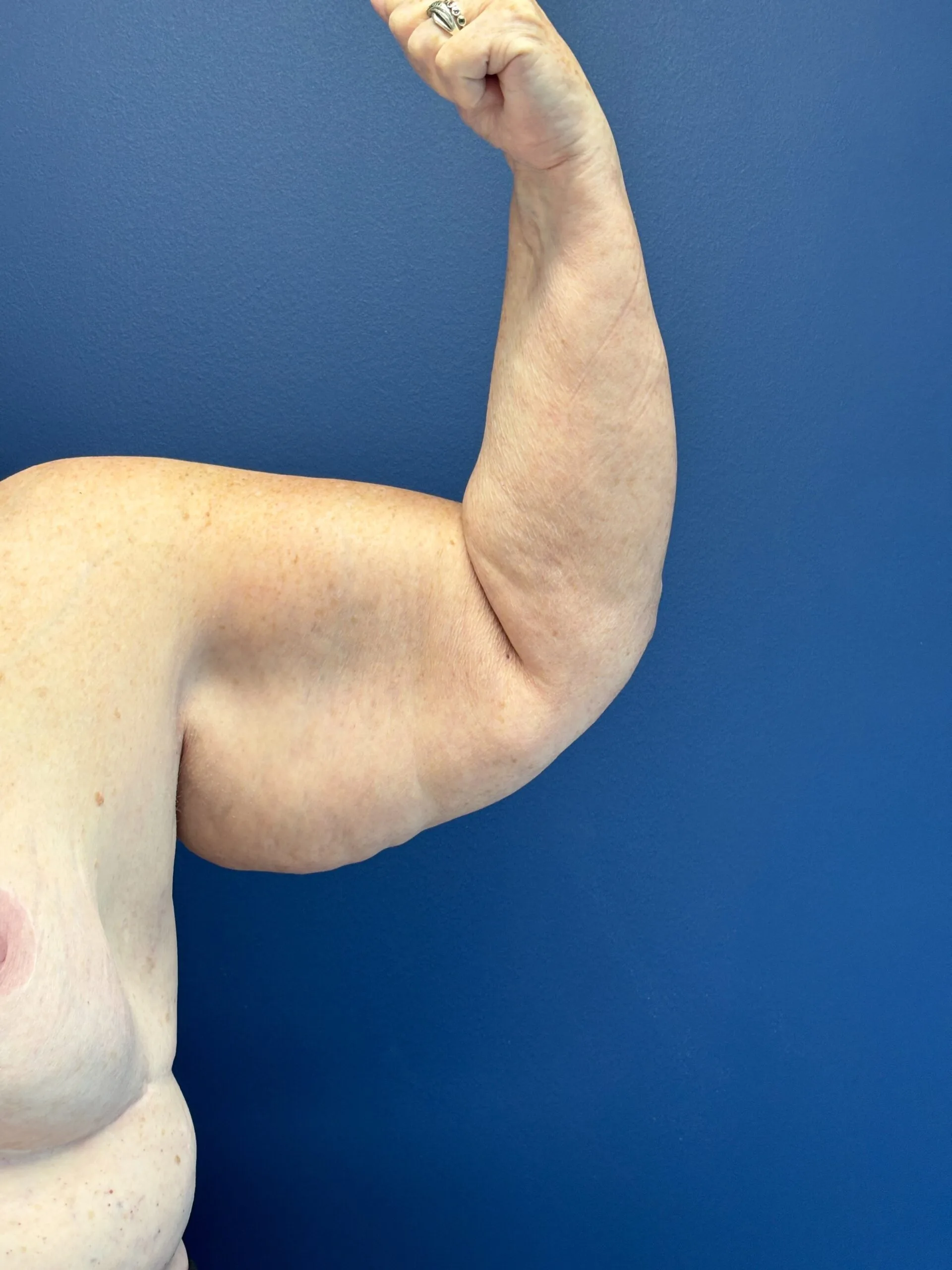 Brachioplasty-Case--5469 | Before Arm Lift 2