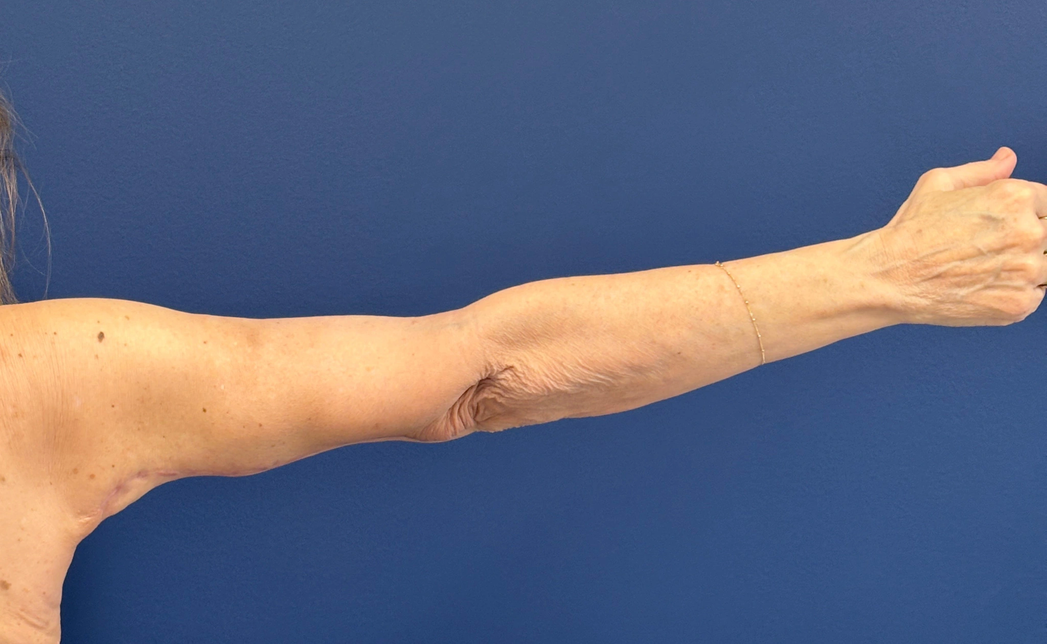 Brachioplasty-Case--3625 | After Arm Lift 7