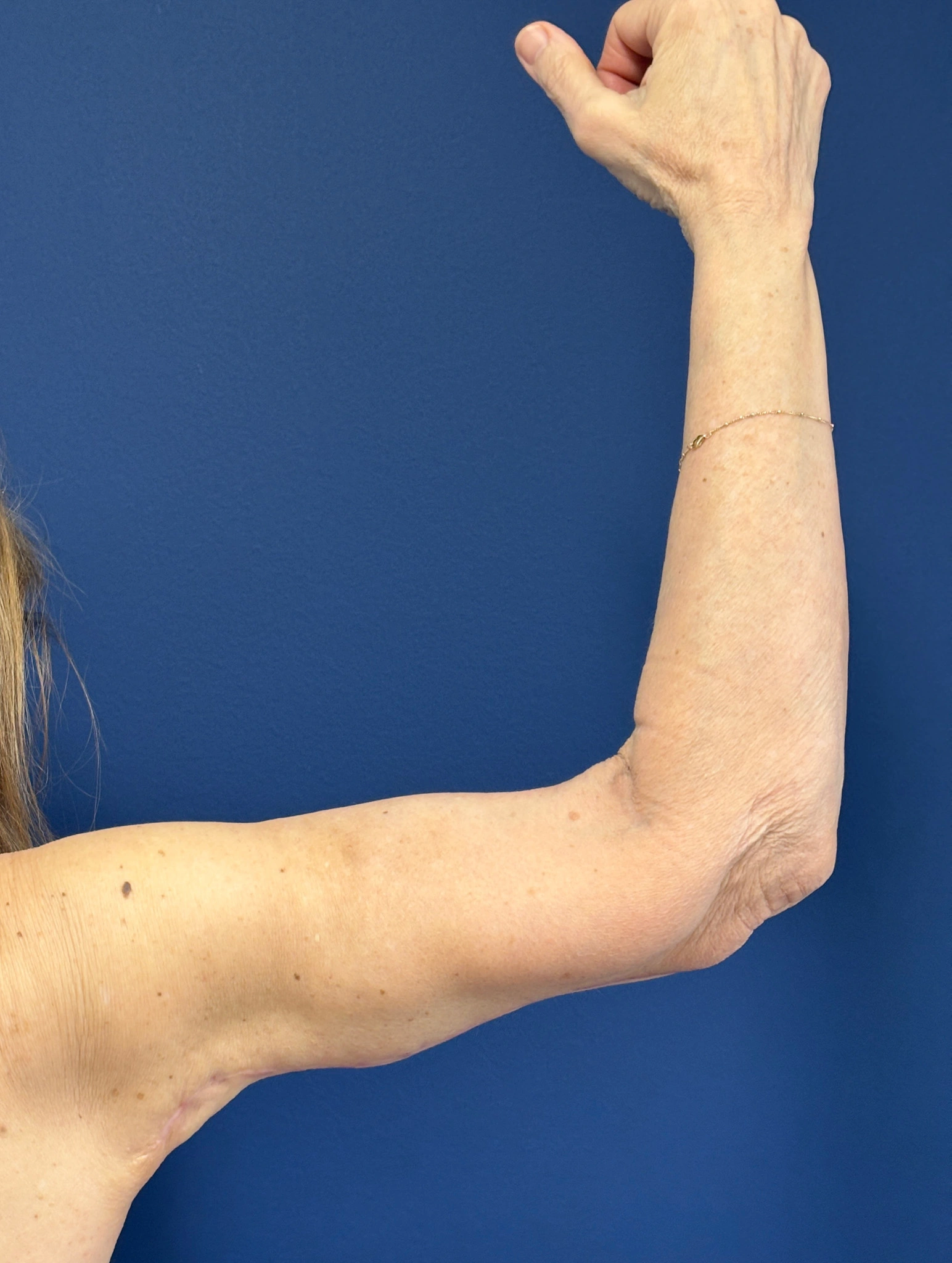 Brachioplasty-Case--3625 | After Arm Lift 3