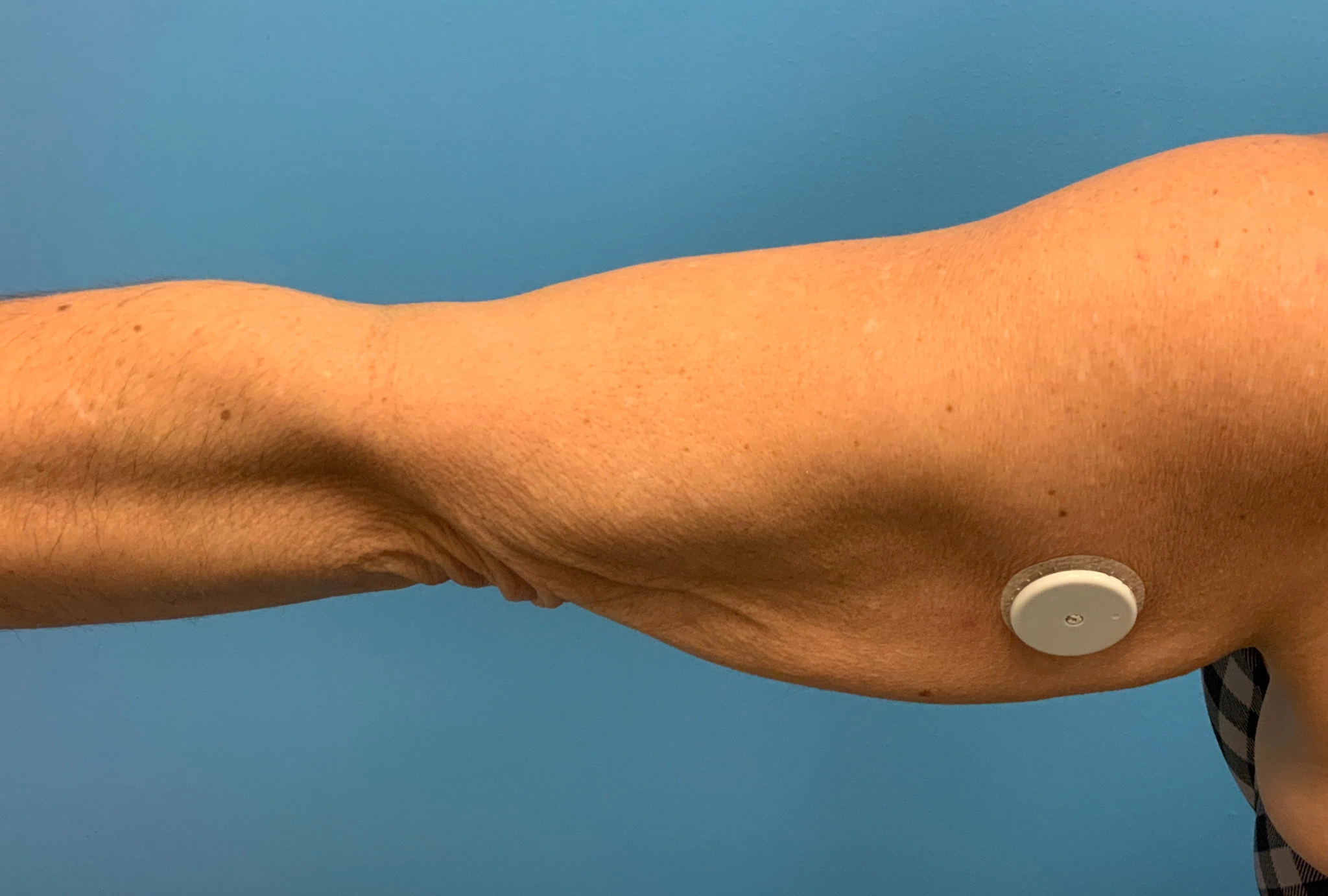 Brachioplasty-Case--2564 | Before Arm Lift 3