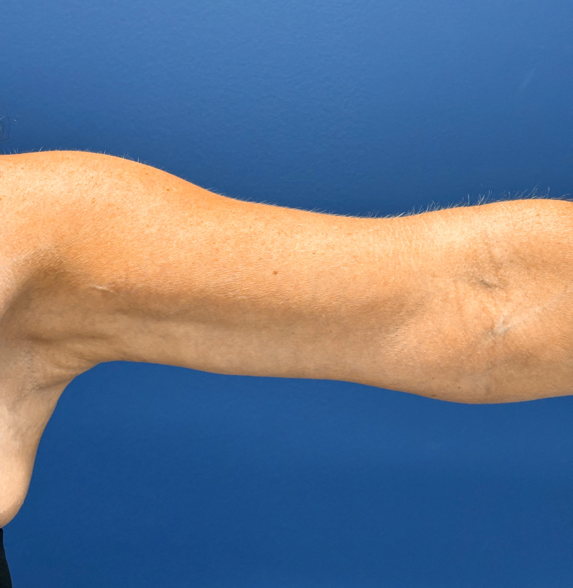 Brachioplasty-Case--2564 | After Arm Lift 1