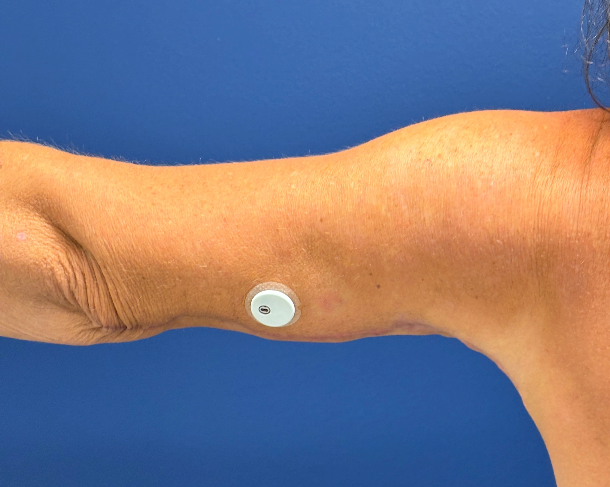 Brachioplasty-Case--2564 | After Arm Lift 3