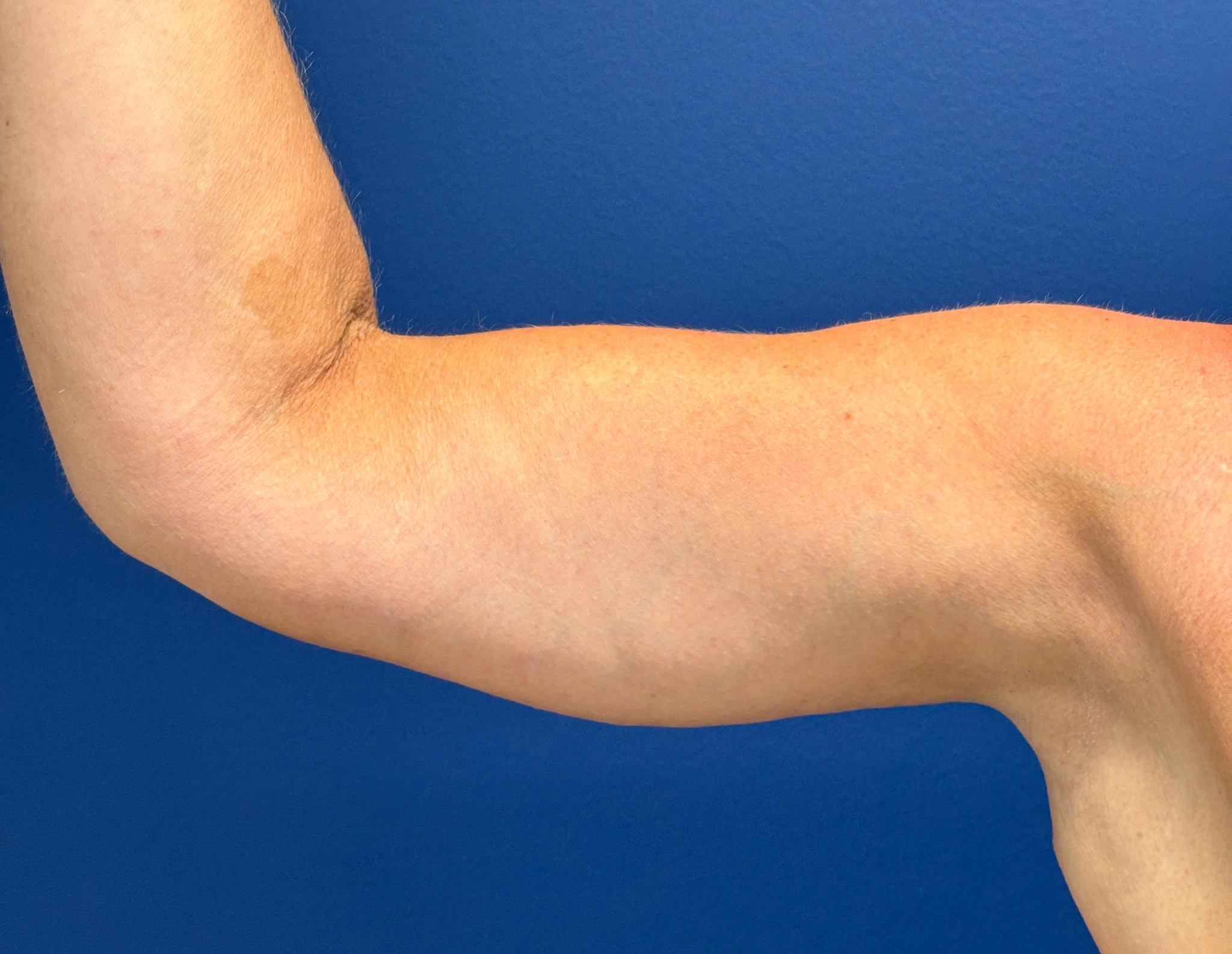 Brachioplasty-Case--2564 | After Arm Lift 4