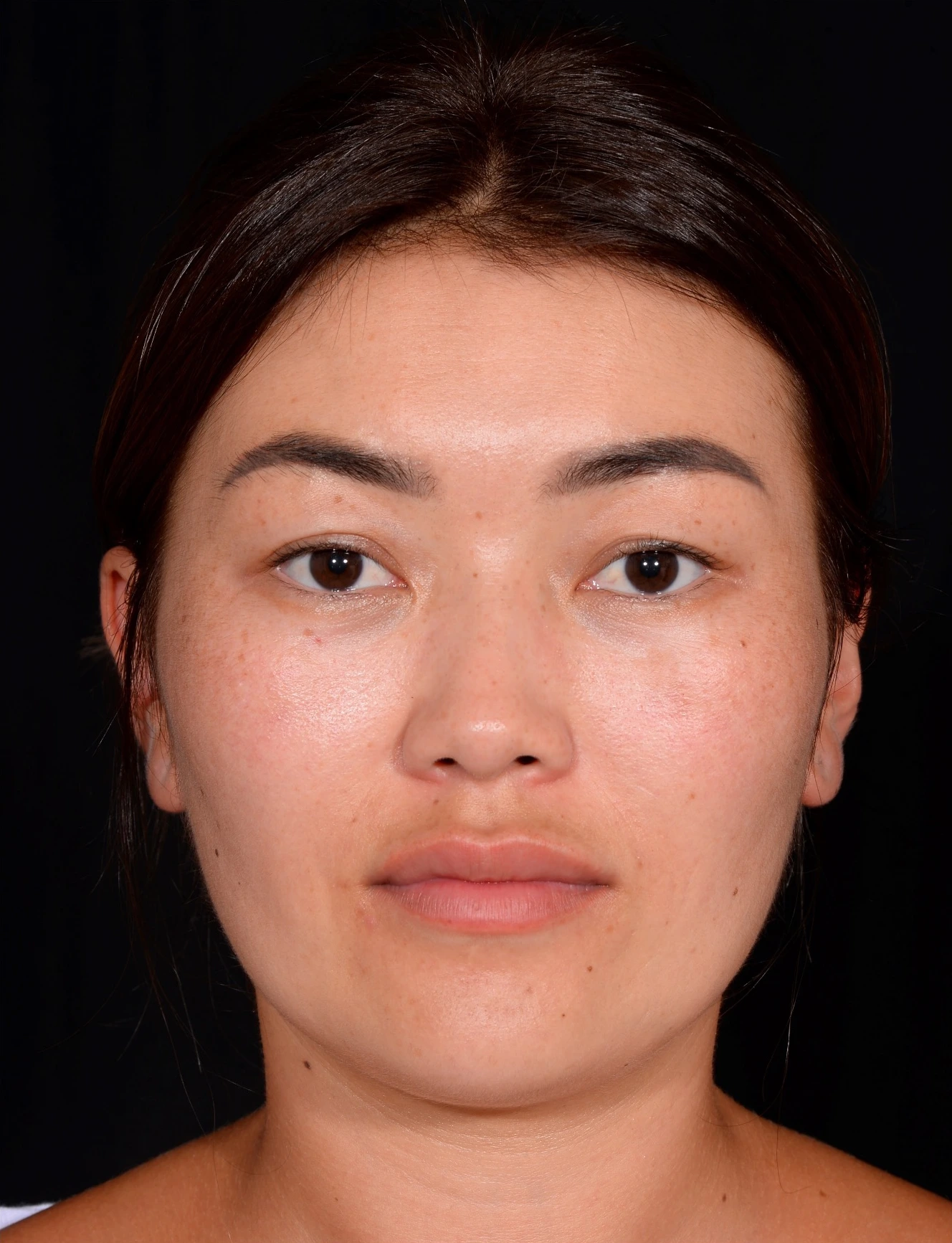 Blepharoplasty-Case--356 | Before Eyelid Surgery 4