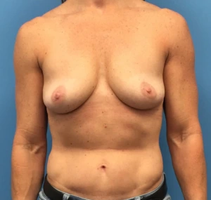 Breast-Augmentation-Mastopexy-Case--230 | Before Breast Augmentation With Lift 1