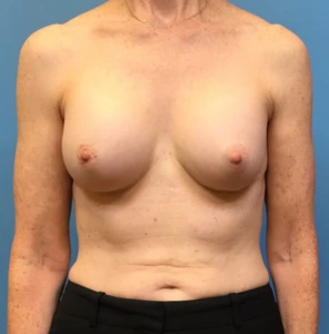 Revision-Augmentation-Case--236 | Before Dr. Samir Rao 1