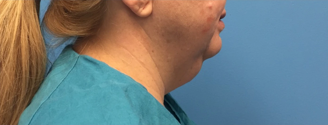 Case--391 | Before Submental Liposuction 1