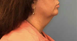 Case--392 | Before Submental Liposuction 1