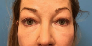 Upper-Blepharoplasty-Case--393 | Before Eyelid Surgery 1