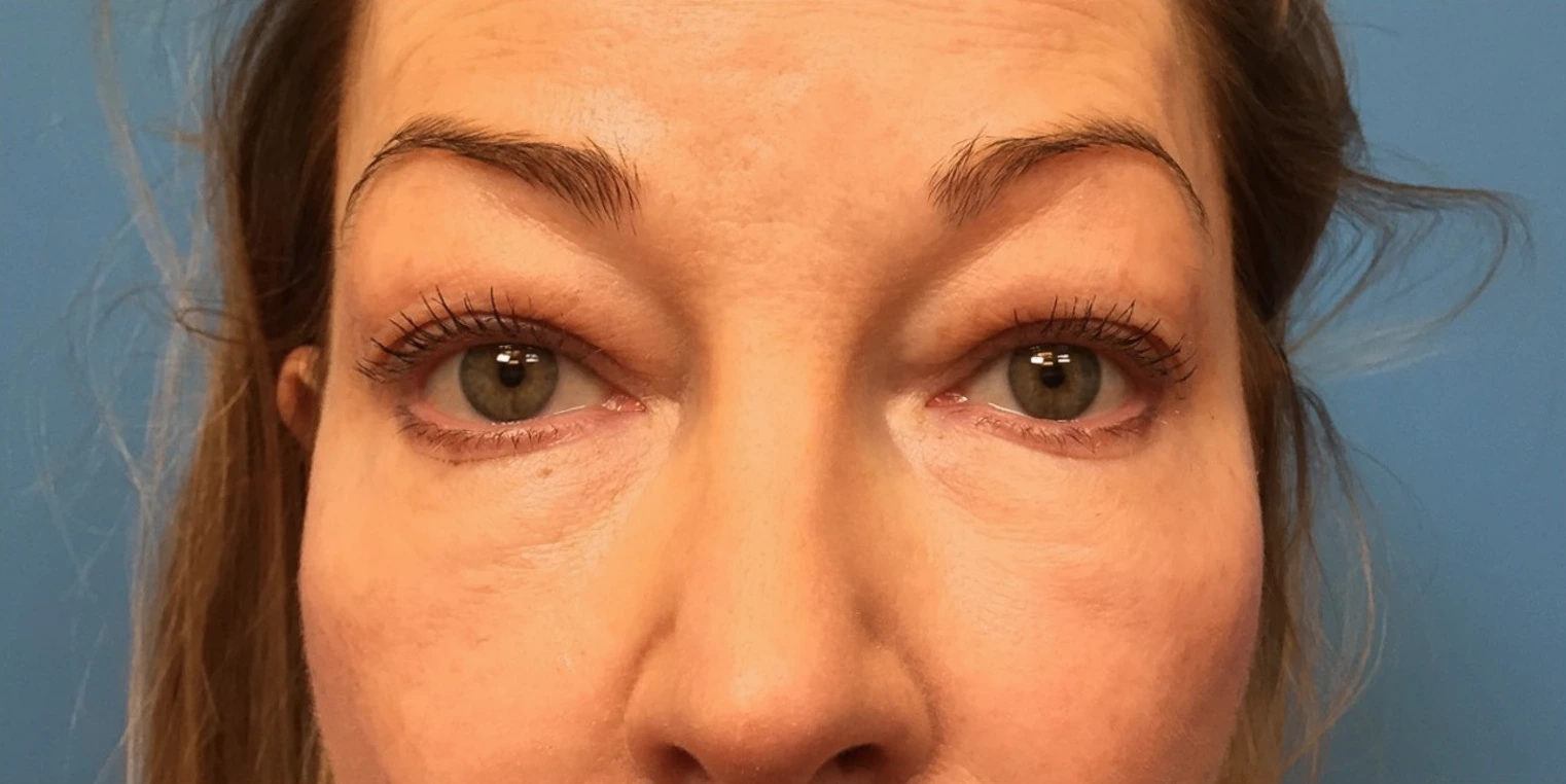 Upper-Blepharoplasty-Case--393 | Before Eyelid Surgery 1