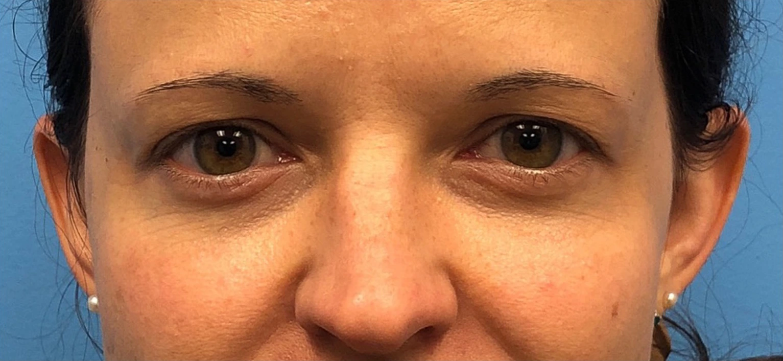Upper-Blepharoplasty-Case--14261 | Before Eyelid Surgery 1