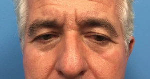 Upper-Blepharoplasty-Case--288 | Before Eyelid Surgery 1