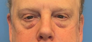 Lower-Blepharoplasty-Case--289 | Before Eyelid Surgery 1