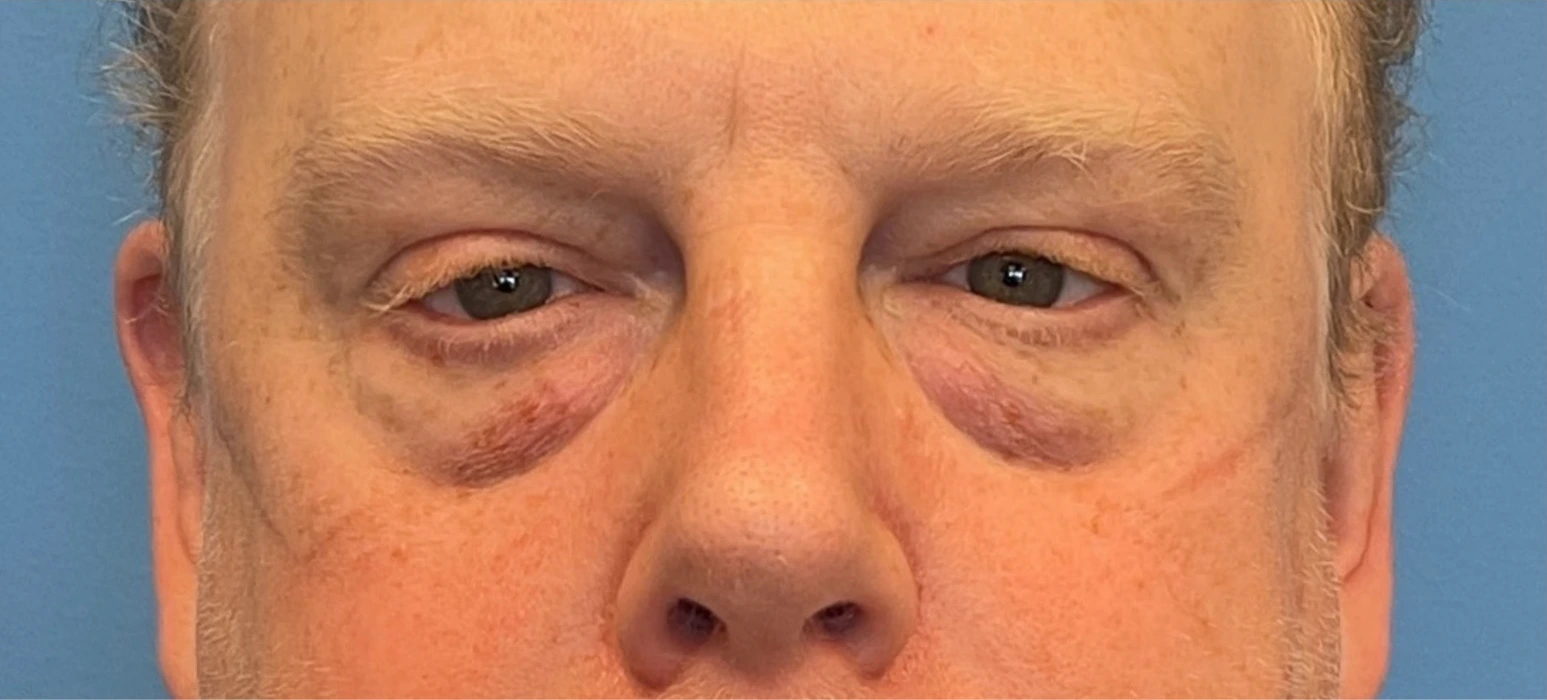 Lower-Blepharoplasty-Case--289 | Before Eyelid Surgery 1