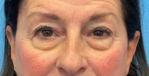 Lower-Blepharoplasty-Case--26440 | Before Eyelid Surgery 1
