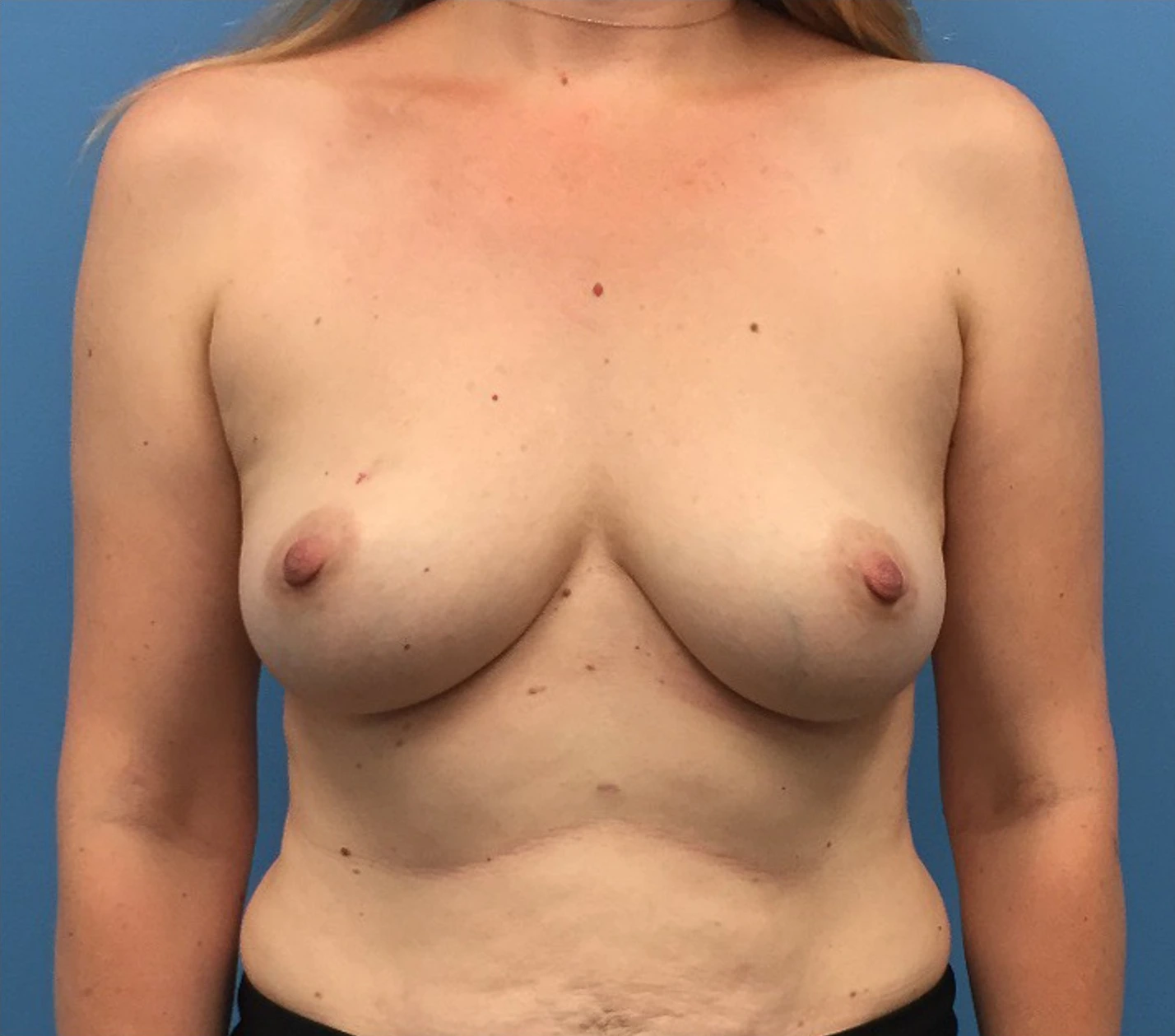 Breast-Reconstruction-Case--295 | Before Breast Reconstruction 1
