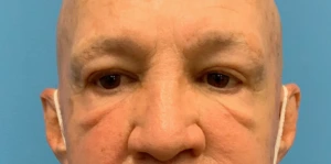 Blepharoplasty-Case--24169 | Before Eyelid Surgery 1