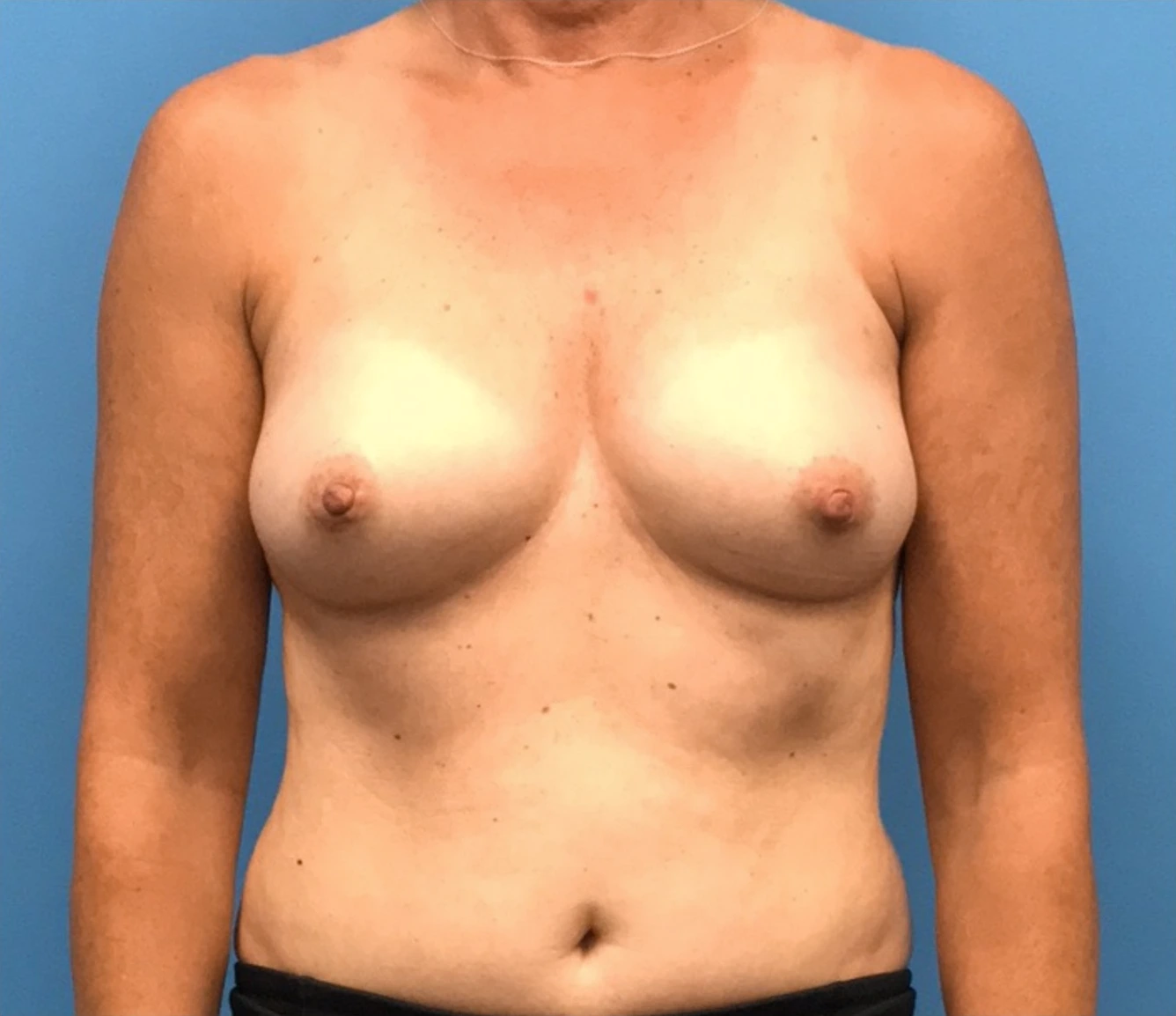 Breast-Reconstruction-Case--310 | Before Breast Reconstruction 1
