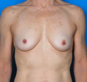 Breast-Reconstruction-Case--312 | Before Dr. Samir Rao 1