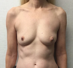 Breast-Reconstruction-Case--313 | Before Dr. Samir Rao 1