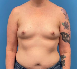 Breast-Reconstruction-Case--335 | Before Dr. Samir Rao 1