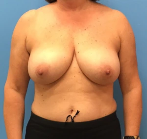 Case--314 | Before Dr. Samir Rao 1