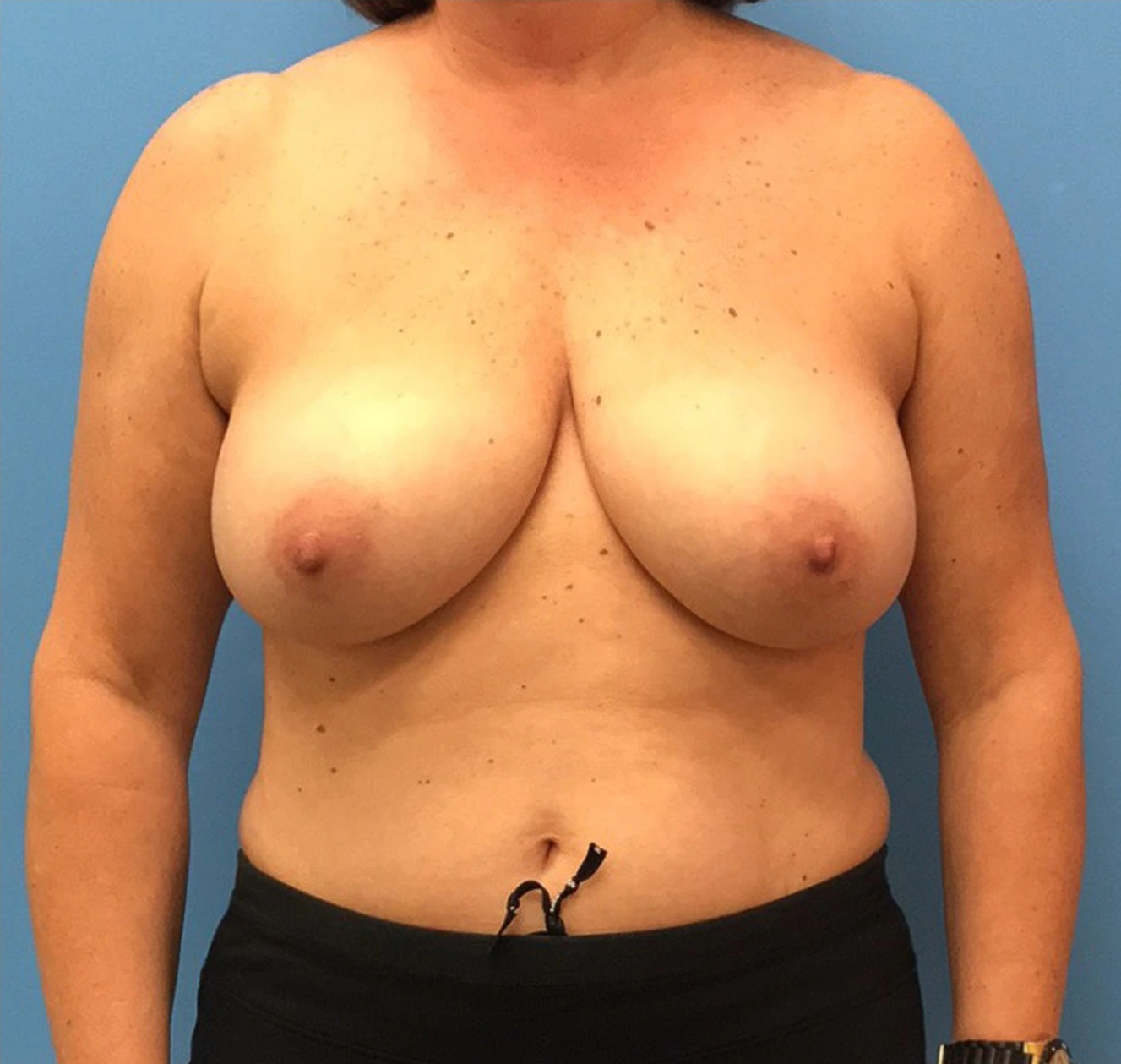 Case--314 | Before Breast Reconstruction 1