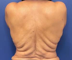 Body-Lift-Case--274 | Before Dr. Samir Rao 1