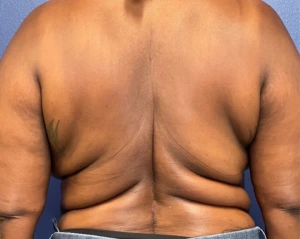 Body-Lift-Case--275 | Before Dr. Samir Rao 1