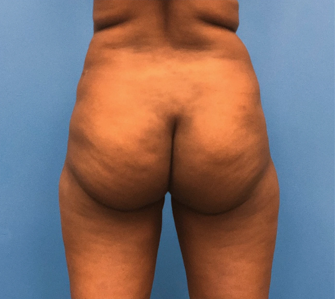 Brazilian-Butt-Lift-Case--267 | Before Brazilian Butt Lift 3
