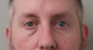Lower-Blepharoplasty-Case--359 | Before Eyelid Surgery 2